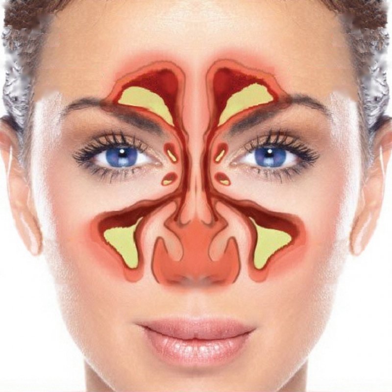 inflamația cartilajului a nasului