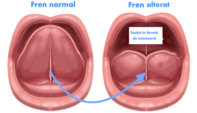 Ce este frenul lingual si cum se face frenectomia?