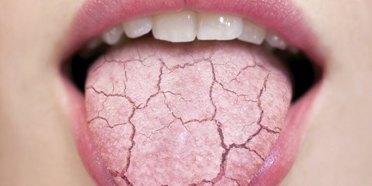 Xerostomia (gura uscată) - de ce apare și cum se tratează?