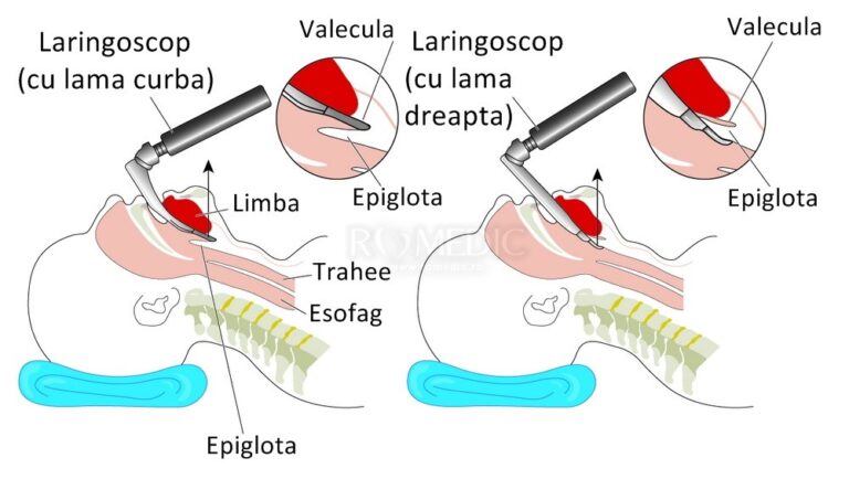 Cum se face laringoscopia?