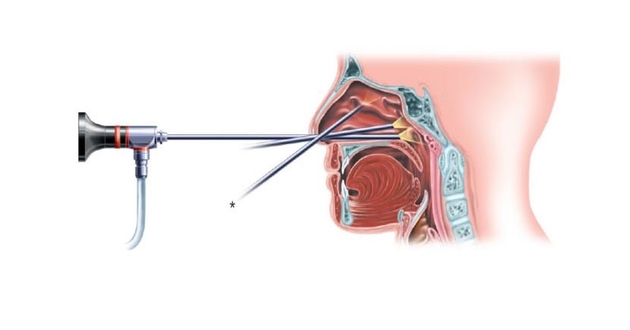 Chirurgia sinusurilor maxilare (Antrostomia maxilară)